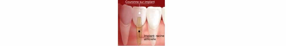couronne-implant-dentaire